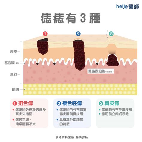 凸痣流血 空氣中的水蒸氣